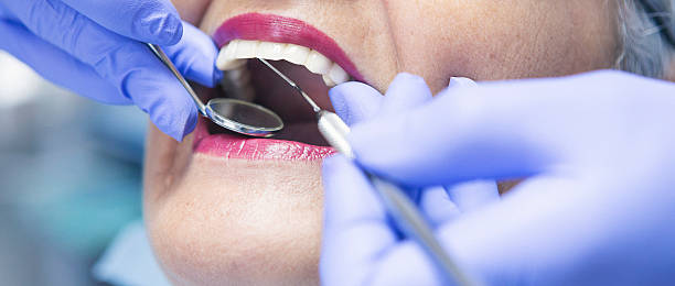 Best Emergency Wisdom Teeth Removal in Duson, LA
